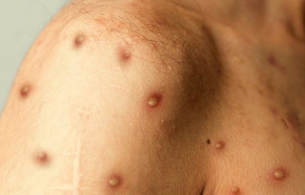 En el Magdalena: primera campaña revolucionaria contra viruela del mono