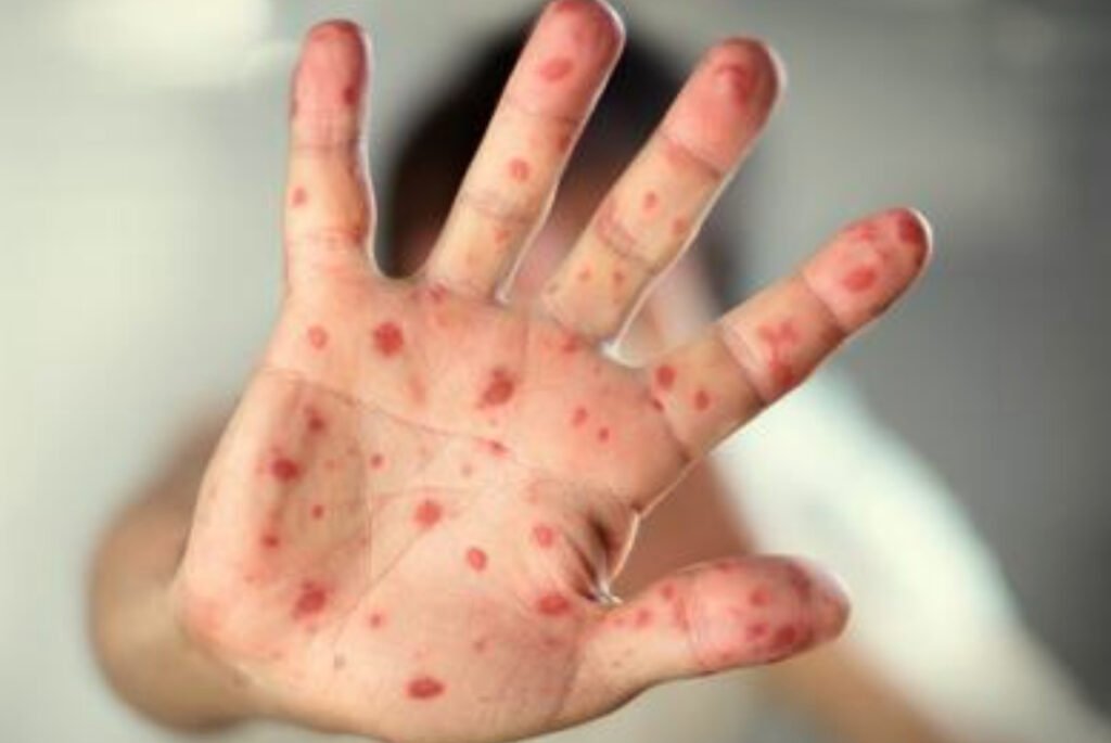 ¡Atención! Hay un segundo caso de viruela símica en el Magdalena